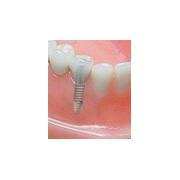 Implante dentare